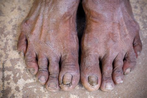 disgusting feet photos|ugly gross feet.